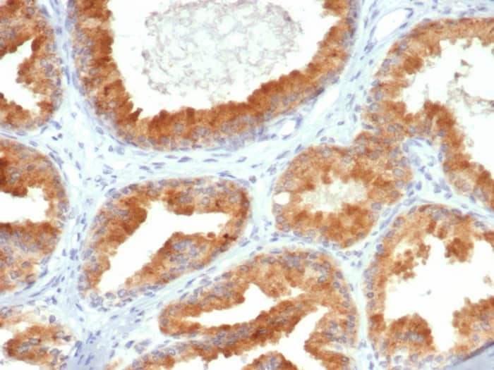Formalin-fixed, paraffin-embedded human prostate cancer stained with AIBZIP antibody (PCRP-CREB3L4-1A3). HIER: Tris/EDTA, pH9.0, 45min. Secondary: HRP-polymer, 30min. DAB, 5min.