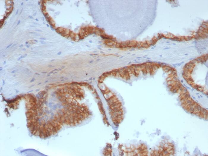 Formalin-fixed, paraffin-embedded human prostate stained with beta-Catenin antibody (rCTNNB1/8043). HIER: Tris/EDTA, pH9.0, 45min. Secondary: HRP-polymer, 30min. DAB, 5min.