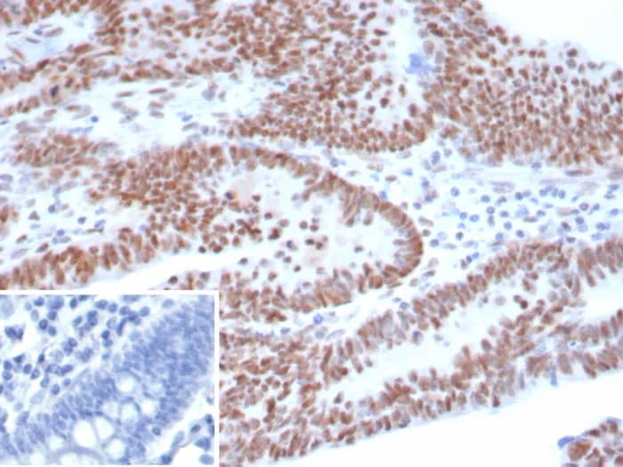 Formalin-fixed, paraffin-embedded human ovarian carcinoma stained with p53 Antibody (TP53/8183R). Inset: PBS instead of primary antibody; secondary only negative control.