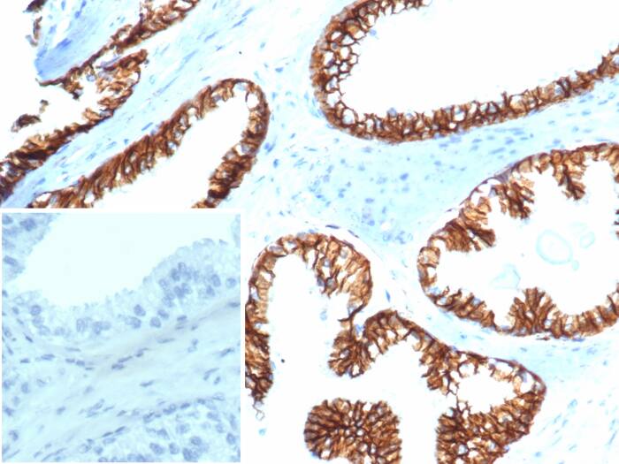 Formalin-fixed, paraffin-embedded human prostate carcinoma stained with beta-Catenin antibody (CTNNB1/6807R). Inset: PBS instead of primary antibody; secondary only negative control