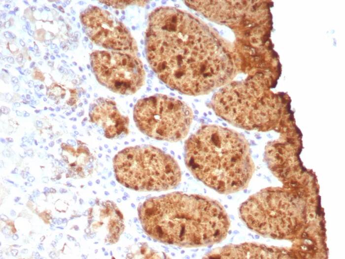 Immunohistochemistry-Paraffin: TAG-72 Antibody (rTAG72/9132) [NBP3-23722] - Formalin-fixed, paraffin-embedded human colon stained with TAG-72 Antibody (rTAG72/9132). HIER: Tris/EDTA, pH9.0, 45min. 2°C: HRP-polymer, 30min. DAB, 5min.