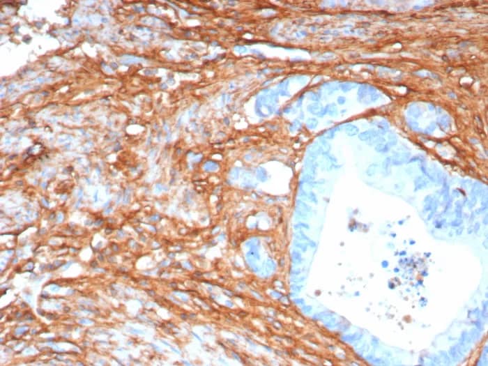 Immunohistochemistry-Paraffin: Periostin/OSF-2 Antibody (POSTN/8165R) [NBP3-23726] - Formalin-fixed, paraffin-embedded human colon stained with Periostin/OSF-2 Antibody (POSTN/8165R). HIER: Tris/EDTA, pH9.0, 45min. 2°C: HRP-polymer, 30min. DAB, 5min.