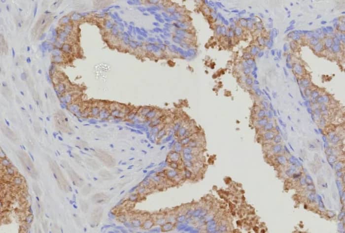 Immunohistochemistry-Paraffin: Thymidylate Synthase Antibody (TYMS/9091R) [NBP3-23732] - Formalin-fixed, paraffin-embedded human prostate carcinoma stained with Thymidylate Synthase Antibody (TYMS/9091R). HIER: Tris/EDTA, pH9.0, 45min. 2°C: HRP-polymer, 30min. DAB, 5min.