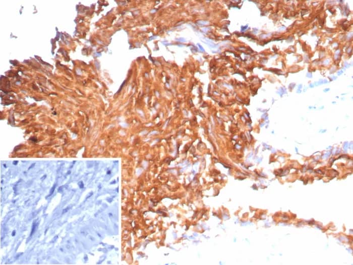 Immunohistochemistry-Paraffin: Uroplakin Ib Antibody (UPK1B/9258R) [NBP3-23752] - Formalin-fixed, paraffin-embedded human bladder carcinoma stained with Uroplakin Ib Antibody (UPK1B/9258R). Inset: PBS instead of primary antibody; secondary only negative control.