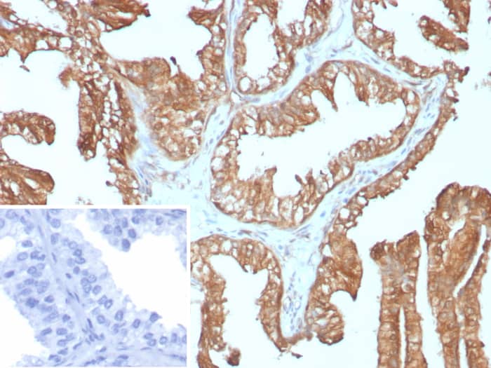 Formalin-fixed, paraffin-embedded human prostate carcinoma stained with RPS23 antibody (rYWHAE/8860). HIER: Tris/EDTA, pH9.0, 45min. Secondary: HRP-polymer, 30min. DAB, 5min.