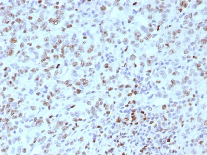 Formalin-fixed, paraffin-embedded human Lynch disease colon stained with MLH1 antibody (rMLH1/8630). HIER: Tris/EDTA, pH9.0, 45min. Secondary: HRP-polymer, 30min. DAB, 5min.
