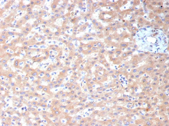Immunohistochemistry-Paraffin: ALDH1L1 Antibody (ALDH1L1/7959) [NBP3-23773] - Formalin-fixed, paraffin-embedded human hepatocellular carcinoma stained with ALDH1L1 Antibody (ALDH1L1/7959). HIER: Tris/EDTA, pH9.0, 45min. 2°C: HRP-polymer, 30min. DAB, 5min.