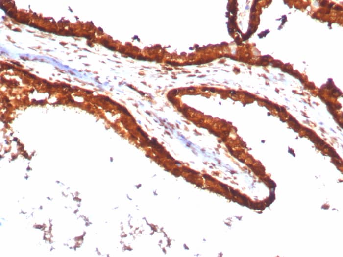 Formalin-fixed, paraffin-embedded human prostate carcinoma stained with RPS23 antibody (YWHAE/8636R). HIER: Tris/EDTA, pH9.0, 45min. Secondary: HRP-polymer, 30min. DAB, 5min.