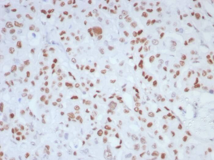 Formalin-fixed, paraffin-embedded human colon stained with MLH1 antibody (MLH1/8855R). HIER: Tris/EDTA, pH9.0, 45min. Secondary: HRP-polymer, 30min. DAB, 5min.