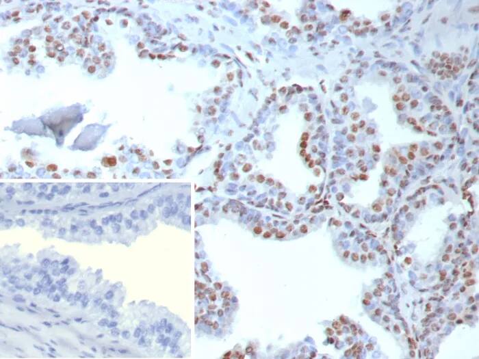 Immunohistochemistry-Paraffin: TDP-43/TARDBP Antibody (TARDP/9299R) [NBP3-23805] - Formalin-fixed, paraffin-embedded human prostate stained with TDP-43/TARDBP Antibody (TARDP/9299R). Inset: PBS instead of primary antibody; secondary only negative control.