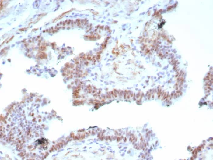 Immunohistochemistry-Paraffin: Androgen Receptor V7 Antibody (DHTR.V7/9125R) [NBP3-23818] - Formalin-fixed, paraffin-embedded human prostate carcinoma stained with Androgen Receptor V7 Antibody (DHTR.V7/9125R). HIER: Tris/EDTA, pH9.0, 95°C/45min. 2°CAb: HRP-Poly:30min. DAB:5min.