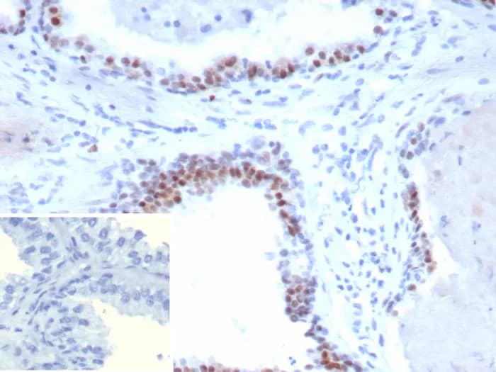 Immunohistochemistry-Paraffin: Androgen Receptor V7 Antibody (DHTR.V7/9394R) [NBP3-23821] - Formalin-fixed, paraffin-embedded human prostate carcinoma stained with Androgen Receptor V7 Antibody (DHTR.V7/9394R). HIER: Tris/EDTA, pH9.0, 95°C/45min. 2°CAb: HRP-Poly:30min. DAB:5min.