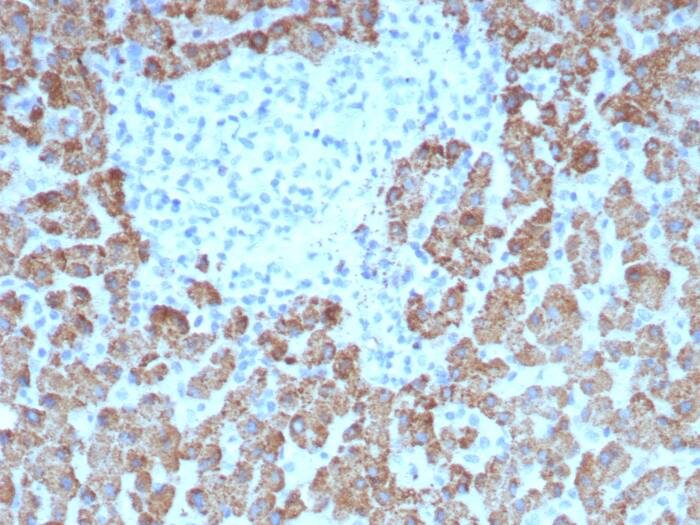 Formalin-fixed, paraffin-embedded human hepatocellular carcinoma stained with CPS1 antibody (CPS1/8417). HIER: Tris/EDTA, pH9.0, 45min. Secondary: HRP-polymer, 30min. DAB, 5min.