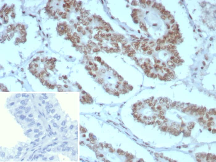 Formalin-fixed, paraffin-embedded human prostate stained with SNF5 antibody (rINI1/8850) Inset: PBS instead of primary antibody; secondary only negative control.