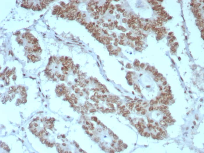 Formalin-fixed, paraffin-embedded human prostate stained with SNF5 antibody (rINI1/8850) HIER: Tris/EDTA, pH9.0, 45min. Secondary: HRP-polymer, 30min. DAB, 5min.