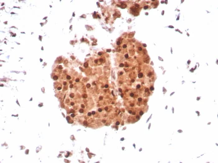 Immunohistochemistry-Paraffin: SNF5 Antibody (SMARCB1/8851R) [NBP3-23874] - Formalin-fixed, paraffin-embedded human sarcoma stained with SNF5 Antibody (SMARCB1/8851R) HIER: Tris/EDTA, pH9.0, 45min. 2°C: HRP-polymer, 30min. DAB, 5min.