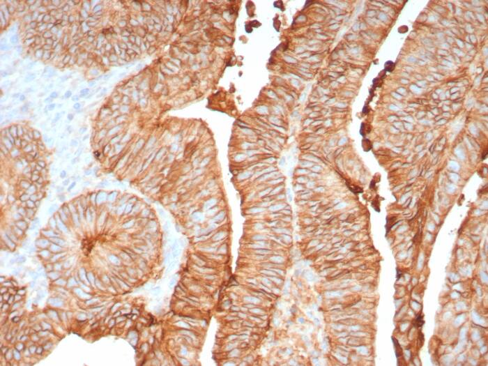 Formalin-fixed, paraffin-embedded human colon stained with Cadherin-17 antibody (CDH17/8158R]). Inset: PBS instead of primary antibody; secondary only negative control.