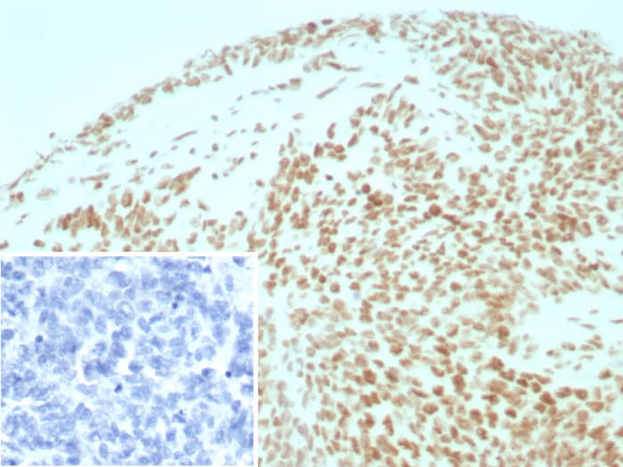 Formalin-fixed, paraffin-embedded human ovarian cancer stained with SNF5 antibody (INI1/8935R) Inset: PBS instead of primary antibody; secondary only negative control.