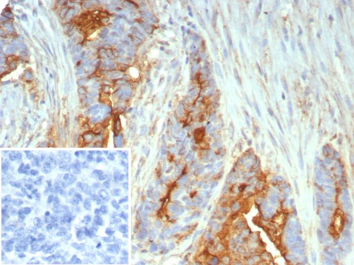 Formalin-fixed, paraffin-embedded human ovarian cancer stained with MUC1 antibody (MUC1/7797R). Inset: PBS instead of primary antibody; secondary only negative control.