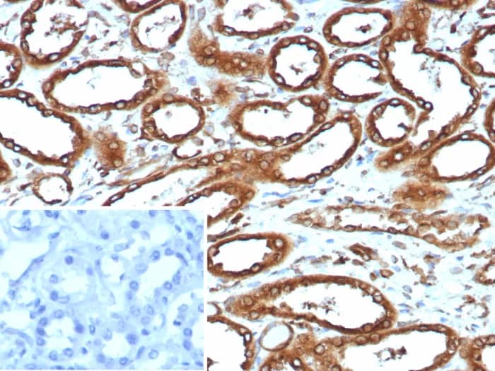 Immunohistochemistry-Paraffin: Calnexin Antibody (CANX/9147R) [NBP3-23890] - Formalin-fixed, paraffin-embedded human renal cell carcinoma stained with Calnexin Antibody (CANX/9147R). HIER: Tris/EDTA, pH9.0, 45min. 2°C: HRP-polymer, 30min. DAB, 5min.