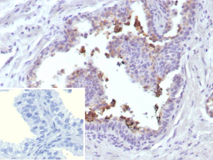 Formalin-fixed, paraffin-embedded human prostate cancer stained with MRP4/ABCC4 antibody (ABCC4/9018). Inset: PBS instead of primary antibody; secondary only negative control.