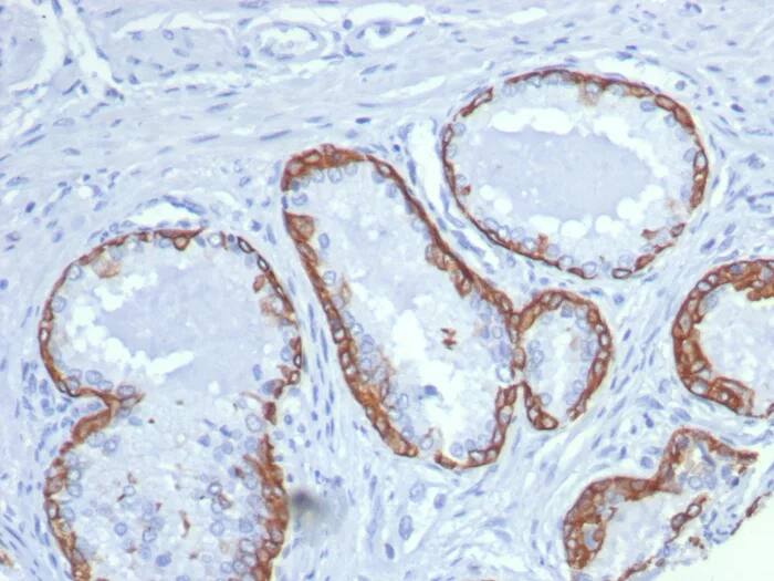 Immunohistochemistry-Paraffin: Cytokeratin 14 Antibody (KRT14/8260R) [NBP3-23907] - Formalin-fixed, paraffin-embedded human prostate stained with Cytokeratin 14 Antibody (KRT14/8260R). HIER: Tris/EDTA, pH9.0, 45min. 2°C: HRP-polymer, 30min. DAB, 5min.