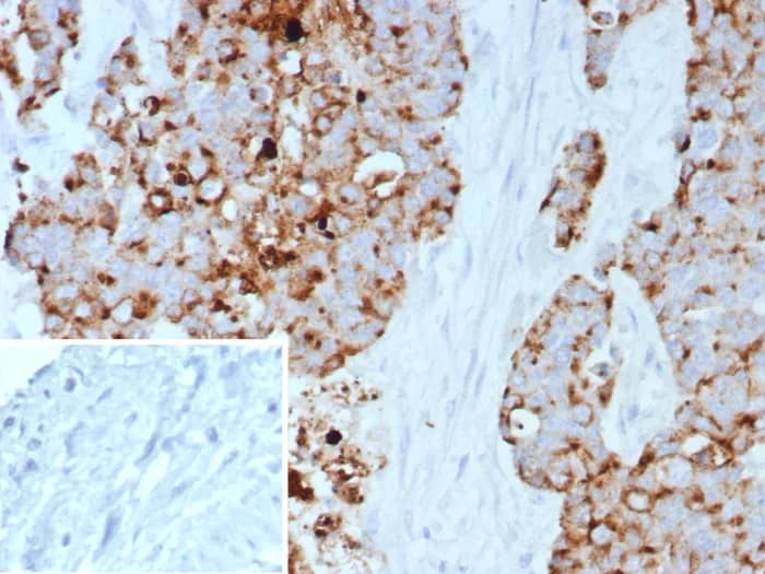 Immunohistochemistry-Paraffin: GPRC5A/RAI3 Antibody (GPRC5A/7893) [NBP3-23915] - Formalin-fixed, paraffin-embedded human bladder carcinoma stained with GPRC5A/RAI3 Antibody (GPRC5A/7893). Inset: PBS instead of primary antibody; secondary only negative control.