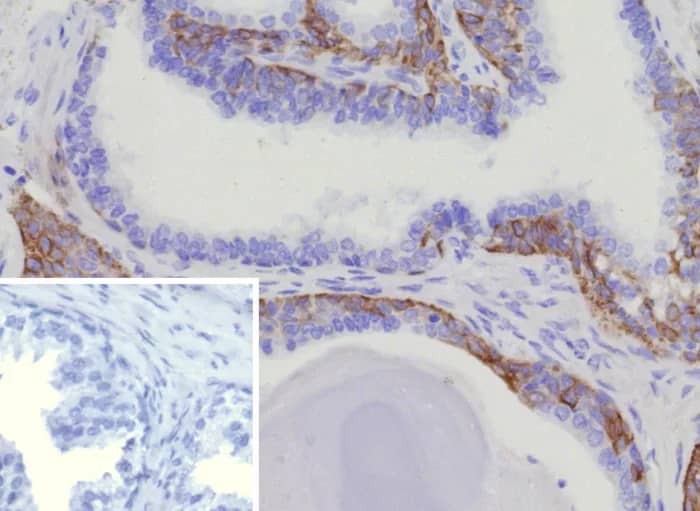 Immunohistochemistry-Paraffin: Cytokeratin 15 Antibody (KRT15/9088R) [NBP3-23919] - Formalin-fixed, paraffin-embedded human prostate cancer stained with Cytokeratin 15 Antibody (KRT15/9088R). Inset: PBS instead of primary antibody; secondary only negative control.