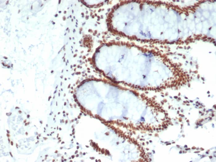 Formalin-fixed, paraffin-embedded human colon carcinoma stained with CDC5L antibody (PCRP-CDC5L-2C6). HIER: Tris/EDTA, pH9.0, 45min. Secondary: HRP-polymer, 30min. DAB, 5min.