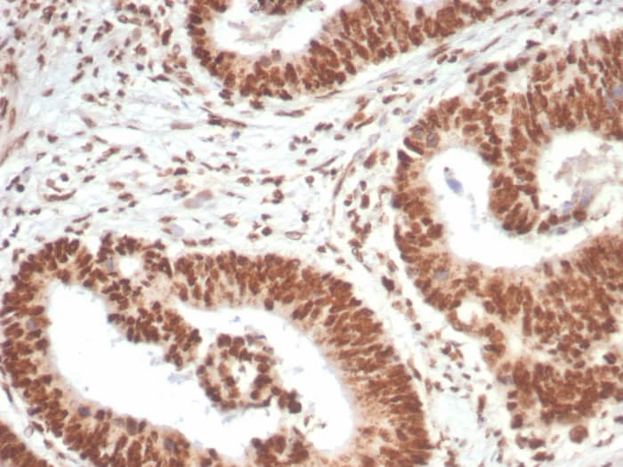 Formalin-fixed, paraffin-embedded human colon carcinoma stained with WTAP antibody (PCRP-WTAP-1A4) - Azide and BSA Free. HIER: Tris/EDTA, pH9.0, 45min. Secondary: HRP-polymer, 30min. DAB, 5min.