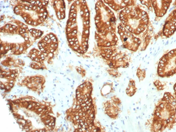 Formalin-fixed, paraffin-embedded human prostate carcinoma stained with TROP-2 antibody (TACSTD2/7349R) - Azide and BSA Free. HIER: Tris/EDTA, pH9.0, 45min. Secondary: HRP-polymer, 30min. DAB, 5min.