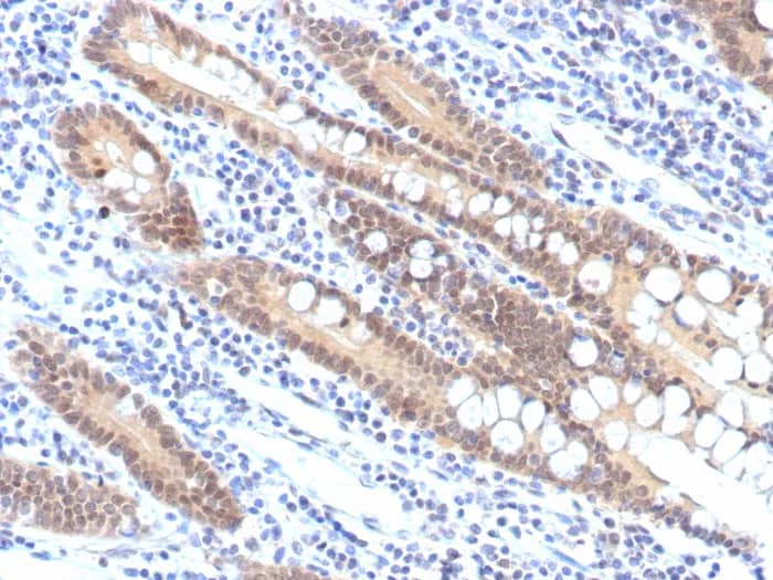 Immunohistochemistry-Paraffin: Smad4 Antibody (SMAD/7906R) - Azide and BSA Free [NBP3-24008] - Formalin-fixed, paraffin-embedded human pancreatic carcinoma stained with Smad4 Antibody (SMAD/7906R). HIER: Tris/EDTA, pH9.0, 45min. 2°C: HRP-polymer, 30min. DAB, 5min.