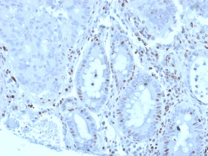 Formalin-fixed, paraffin-embedded human colon carcinoma stained with MZF1 antibody (PCRP-MZF1-1E8) - Azide and BSA Free. HIER: Tris/EDTA, pH9.0, 45min. Secondary: HRP-polymer, 30min. DAB, 5min.