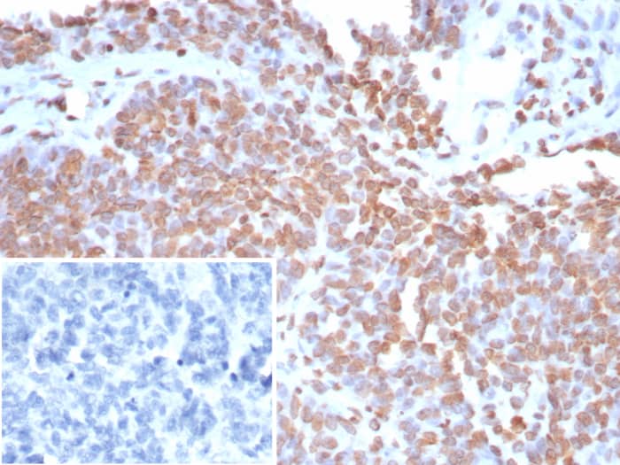 Formalin-fixed, paraffin-embedded human ovarian cancer stained with dsDNA antibody (rDSD/8266) - Azide and BSA Free. Inset: PBS instead of primary antibody; secondary only negative control.