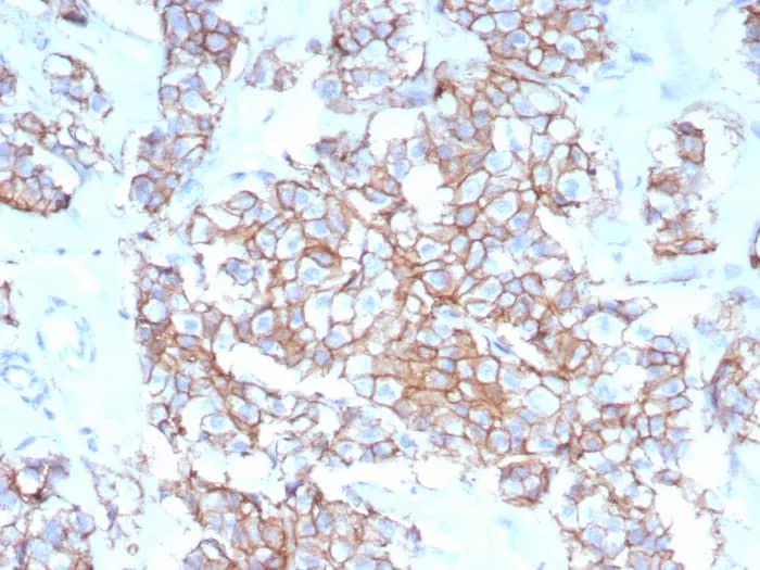 Immunohistochemistry-Paraffin: ErbB2/Her2 Antibody (rERBB2/9401) - Azide and BSA Free [NBP3-24036] - IHC analysis of formalin-fixed, paraffin-embedded human breast carcinoma. Stained using ErbB2/Her2 Antibody (rERBB2/9401) at 2ug/ml in PBS for 30min RT. HIER: Tris/EDTA, pH9.0, 45min. 2°C: HRP-polymer, 30min. DAB, 5min.