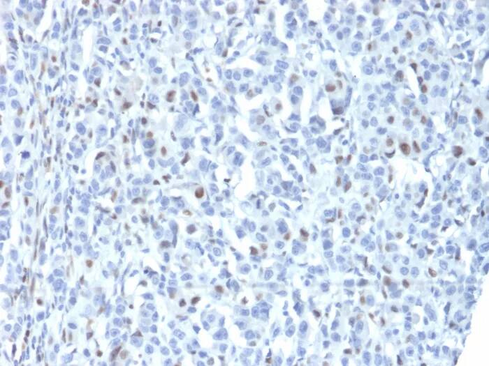 Immunohistochemistry-Paraffin: ZNF232 Antibody (PCRP-ZNF232-1D5) - Azide and BSA Free [NBP3-24040] - Formalin-fixed, paraffin-embedded human tumor of unknown origin stained with ZNF232 Antibody (PCRP-ZNF232-1D5). HIER: Tris/EDTA, pH9.0, 45min. 2°C: HRP-polymer, 30min. DAB, 5min.