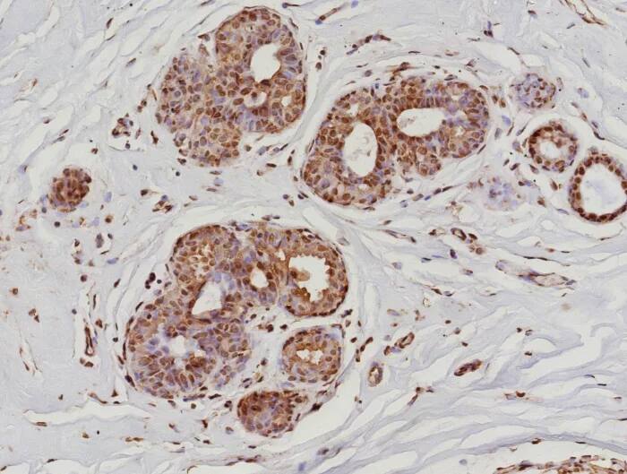 Immunohistochemistry-Paraffin: RNA Polymerase II/POLR2A Antibody (POLR2A/9089R) - Azide and BSA Free [NBP3-24041] - Formalin-fixed, paraffin-embedded human breast cancer stained with RNA Polymerase II/POLR2A Antibody (POLR2A/9089R). HIER: Tris/EDTA, pH9.0, 45min. 2°C: HRP-polymer, 30min. DAB, 5min.