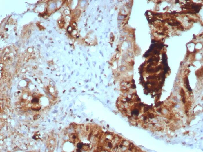 Immunohistochemistry-Paraffin: TAG-72 Antibody (TAG72/8317R) - Azide and BSA Free [NBP3-24049] - Formalin-fixed, paraffin-embedded human colon carcinoma stained with TAG-72 Antibody (TAG72/8317R). HIER: Tris/EDTA, pH9.0, 45min. 2°C: HRP-polymer, 30min. DAB, 5min.