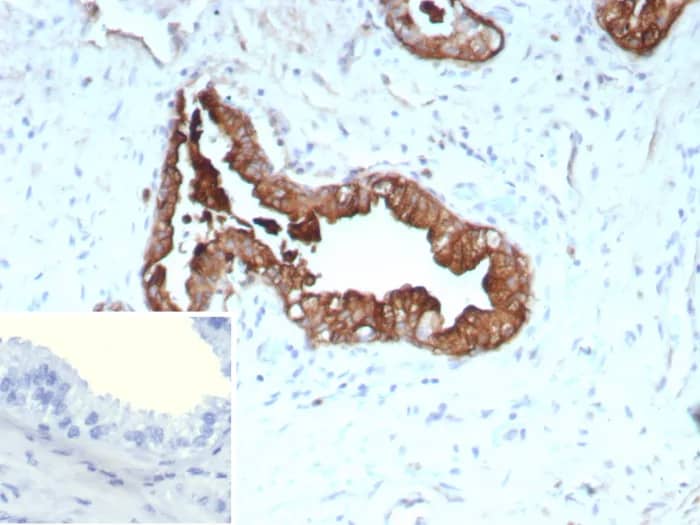 Immunohistochemistry-Paraffin: Cytokeratin 19 Antibody (rKRT19/9108) - Azide and BSA Free [NBP3-24053] - Formalin-fixed, paraffin-embedded human prostate cancer stained with Cytokeratin 19 Antibody (rKRT19/9108). HIER: Tris/EDTA, pH9.0, 45min. 2°C: HRP-polymer, 30min. DAB, 5min.