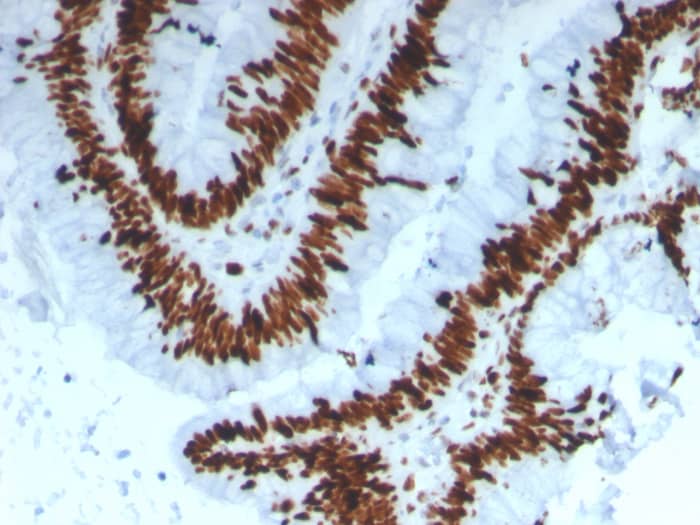 Formalin-fixed, paraffin-embedded human colon carcinoma stained with MCM3 antibody (MCM3/3221) - Azide and BSA Free. HIER: Tris/EDTA, pH9.0, 45min. Secondary: HRP-polymer, 30min. DAB, 5min.