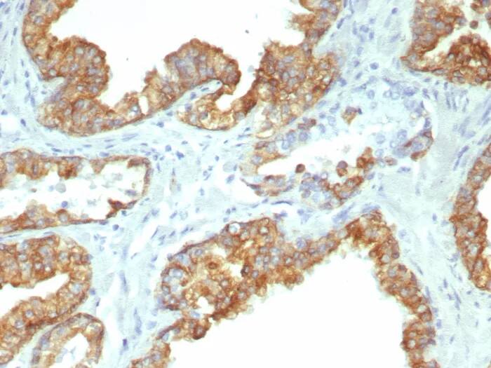 Immunohistochemistry-Paraffin: Cytokeratin 19 Antibody (KRT19/8091R) - Azide and BSA Free [NBP3-24067] - Formalin-fixed, paraffin-embedded human prostate cancer stained with Cytokeratin 19 Antibody (KRT19/8091R). HIER: Tris/EDTA, pH9.0, 45min. 2°C: HRP-polymer, 30min. DAB, 5min.
