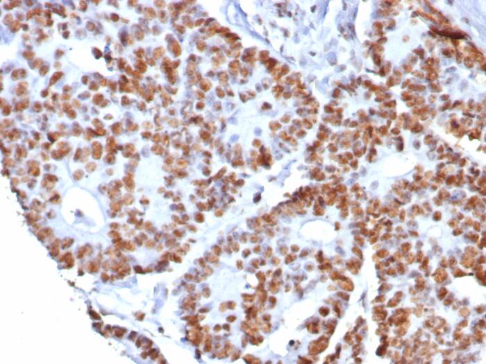 Formalin-fixed, paraffin-embedded human colon cancer stained with Nucleolin antibody (NCL/8068R) - Azide and BSA Free. HIER: Tris/EDTA, pH9.0, 45min. Secondary: HRP-polymer, 30min. DAB, 5min.