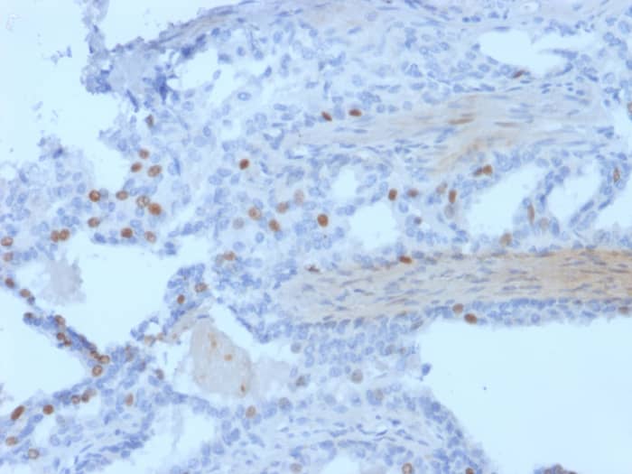 Formalin-fixed, paraffin-embedded human prostate stained with PCGF3 antibody (PCRP-PCGF3-1D5) - Azide and BSA Free HIER: Tris/EDTA, pH9.0, 45min. Secondary: HRP-polymer, 30min. DAB, 5min.