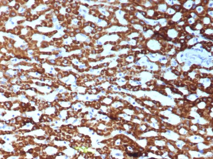 Immunohistochemistry-Paraffin: CPS1 Antibody (CPS1/9151R) - Azide and BSA Free [NBP3-24076] - Formalin-fixed, paraffin-embedded human hepatocellular carcinoma stained with CPS1 Antibody (CPS1/9151R). HIER: Tris/EDTA, pH9.0, 45min. 2°C: HRP-polymer, 30min. DAB, 5min.