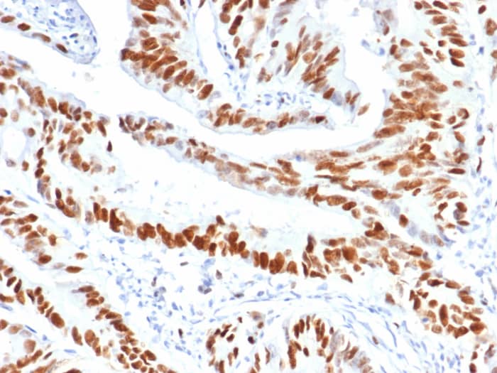 Formalin-fixed, paraffin-embedded human colon carcinoma stained with MCM3 antibody (MCM3/6706) - Azide and BSA Free. HIER: Tris/EDTA, pH9.0, 45min. Secondary: HRP-polymer, 30min. DAB, 5min.