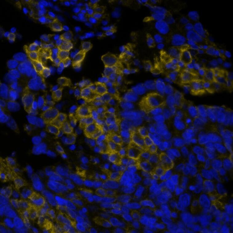 PD-L1 was detected in immersion fixed paraffin-embedded sections of human Lung Tumor using Rabbit Anti-Human PD-L1, Monoclonal Antibody at 5ug/mL at 37°Celsius for 4 minutes. Before incubation with the primary antibody, tissue underwent an all-in-one dewaxing and antigen retrieval preprocessing using PreTreatment Module (PT Module) and Dewax and HIER Buffer H (pH 9; Epredia Catalog # TA-999-DHBH). Tissue was stained using the Alexa Fluor™ Plus 647 Goat anti-Rabbit IgG Secondary Antibody at 1:200 at 37°Celsius for 2 minutes. (Yellow; Lunaphore Catalog # <A class=