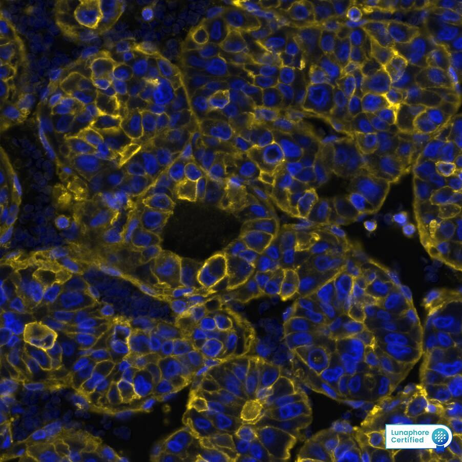 HLA ABC was detected in immersion fixed paraffin-embedded sections of human Liver Tumor using Rabbit Anti-Human HLA ABC, Monoclonal Antibody at 0.15ug/mL at 37°Celsius for 4 minutes. Before incubation with the primary antibody, tissue underwent an all-in-one dewaxing and antigen retrieval preprocessing using PreTreatment Module (PT Module) and Dewax and HIER Buffer H (pH 9; Epredia Catalog # TA-999-DHBH). Tissue was stained using the Alexa Fluor™ Plus 555 Goat anti-Rabbit IgG Secondary Antibody at 1:100 at 37°Celsius for 2 minutes. (Yellow; Lunaphore Catalog # DR555RB) and counterstained with DAPI (blue; Lunaphore Catalog # DR100). Specific staining was localized to the membrane. Protocol available in COMET™ Panel Builder.