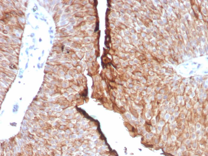 Formalin-fixed, paraffin-embedded human urothelial carcinoma stained with Uroplakin Ib antibody (UPK1B/8976R) - Azide and BSA Free. HIER: Tris/EDTA, pH9.0, 45min. Secondary: HRP-polymer, 30min. DAB, 5min.