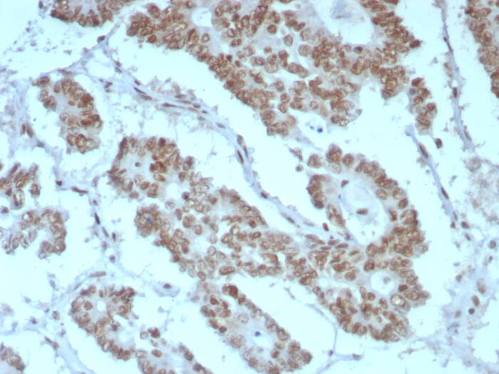 Formalin-fixed, paraffin-embedded human prostate stained with SNF5 antibody (rINI1/8850) - Azide and BSA Free HIER: Tris/EDTA, pH9.0, 45min. Secondary: HRP-polymer, 30min. DAB, 5min.