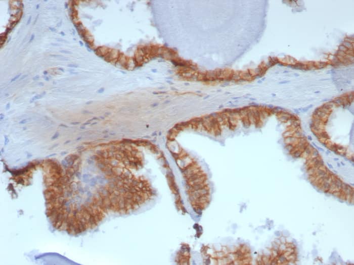 Formalin-fixed, paraffin-embedded human prostate stained with beta-Catenin antibody (rCTNNB1/8043) - Azide and BSA Free. HIER: Tris/EDTA, pH9.0, 45min. Secondary: HRP-polymer, 30min. DAB, 5min.